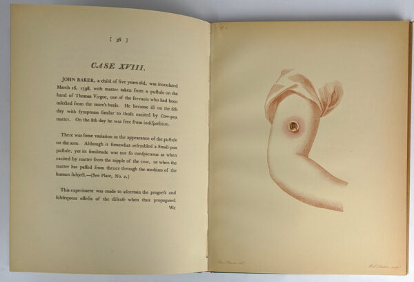 An Inquiry into the Causes and Effects of the Variolae Vaccinae, a Disease Discovered in some of the Western Countries of England, Particularly Gloucestershire, and Known by the Name of The Cow Pox - Image 6