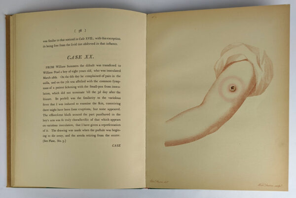 An Inquiry into the Causes and Effects of the Variolae Vaccinae, a Disease Discovered in some of the Western Countries of England, Particularly Gloucestershire, and Known by the Name of The Cow Pox - Image 7