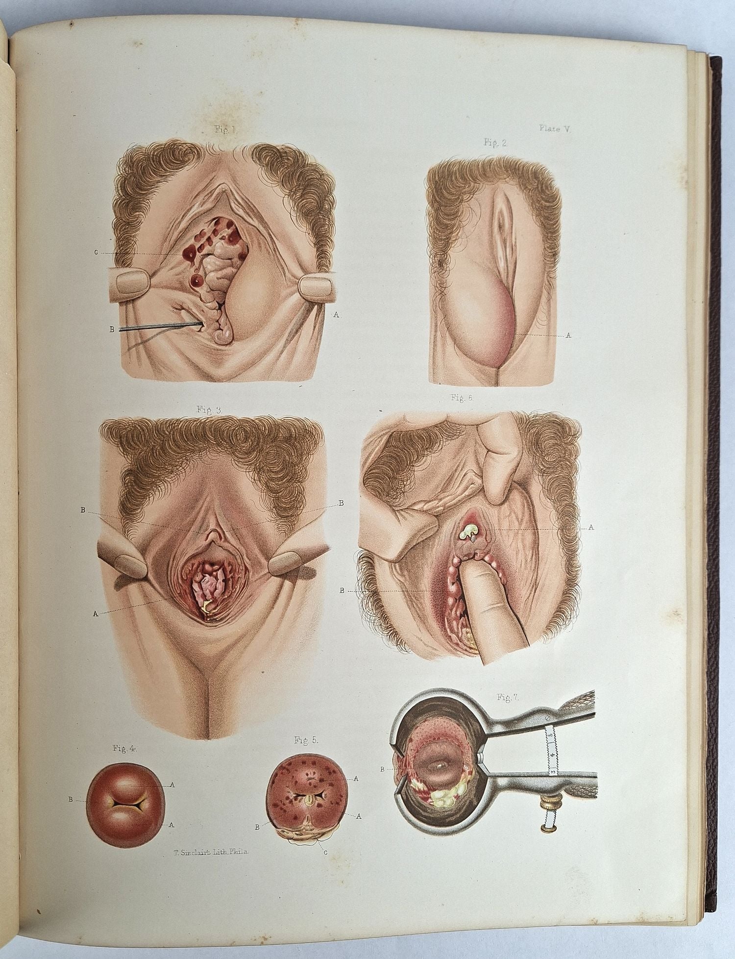 Atlas of Venereal Diseases - Image 5